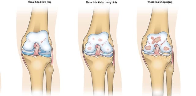 Chữa đau khớp gối ở đâu?