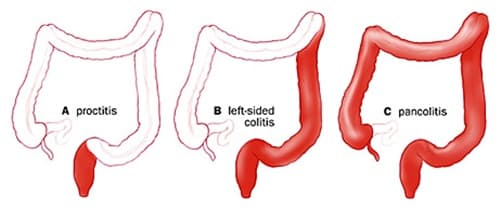viêm loét đại tràng