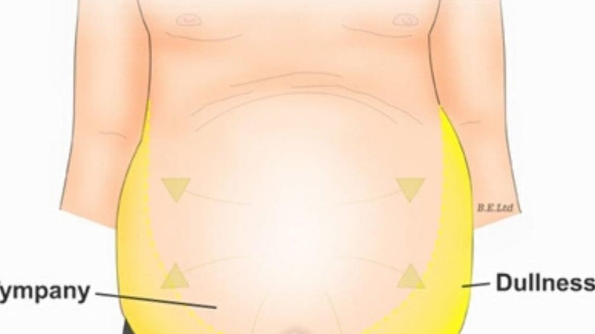 Bệnh xơ gan cổ trướng có lây không?