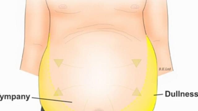 Bệnh xơ gan cổ trướng có lây không?