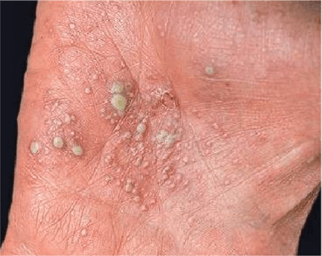 benh-vay-nen-co-chua-duoc-khong