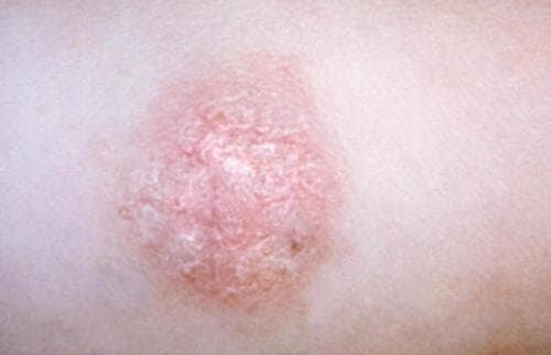 benh-vay-nen-co-chua-duoc-khong2