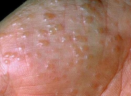 bieu-hien-benh-cham-to-dia