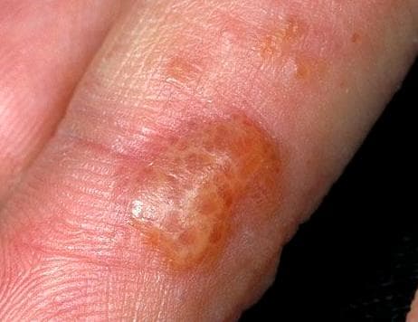 bieu-hien-cua-benh-cham-to-dia1