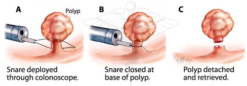 cắt polyp đại tràng