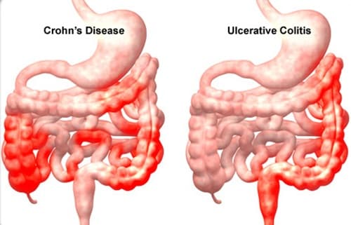 viêm ruột mạn tính ở trẻ em