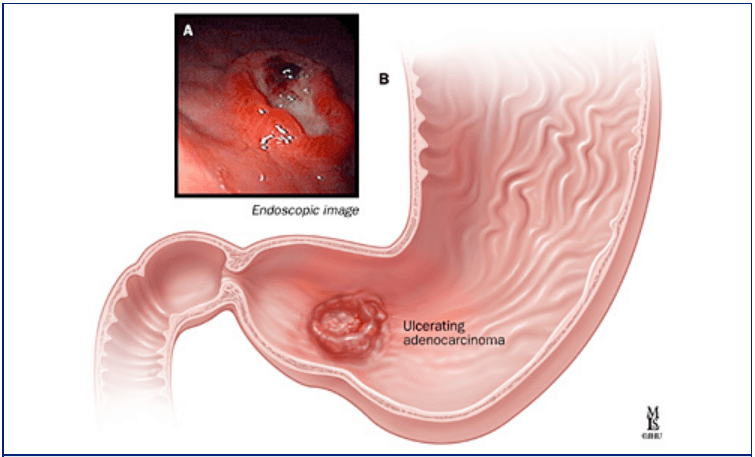 biến chứng của viêm loét dạ dày tá tràng