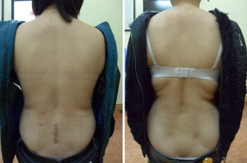 mo-thoat-vi-dia-dem-lan-2