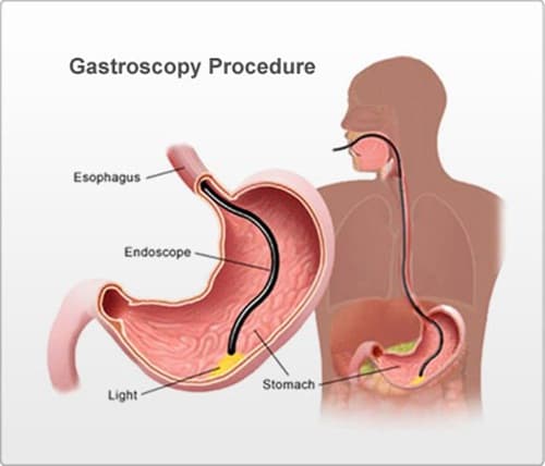 quy trình nội soi dạ dày