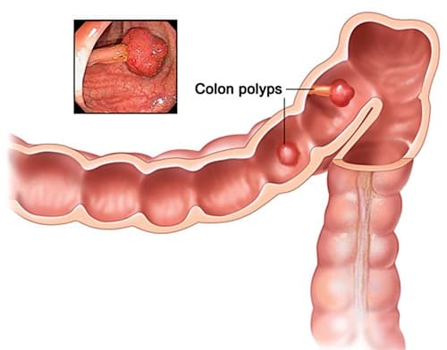 cắt polyp đại tràng