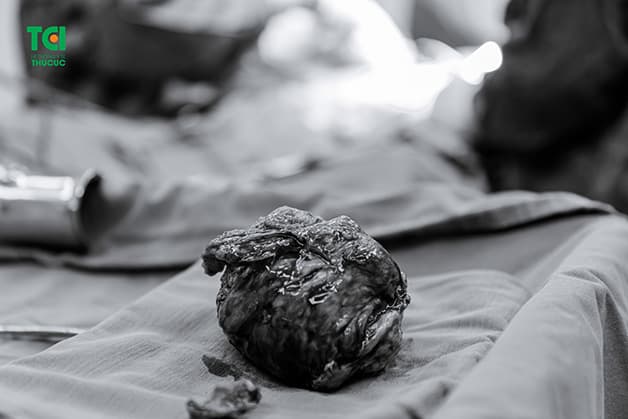 Một khối u xơ tử cung có kích thước 