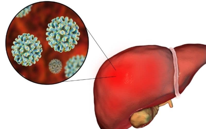 Bệnh viêm gan cấp tính