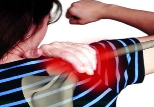 chua-viem-quanh-khop-vai2