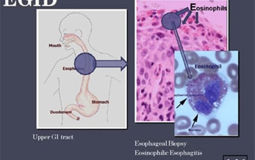 điều trị bệnh viêm thực quản