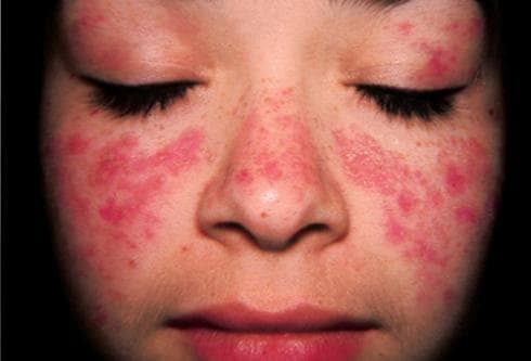 Bệnh lupus ban đỏ có sinh con được không?