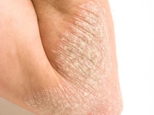 Bệnh vẩy nến có để lại sẹo không?