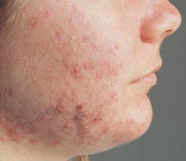 benh-viem-da-di-ung1