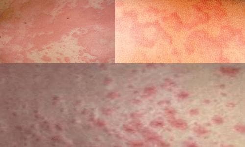 benh-viem-da-di-ung2