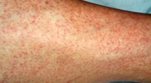 bieu-hien-sot-xuat-huyet.jpg2