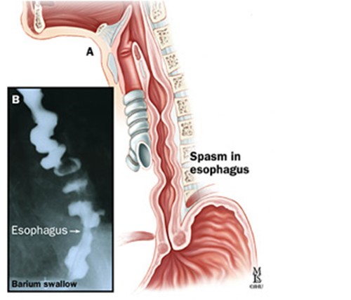 điều trị bệnh co thắt tâm vị