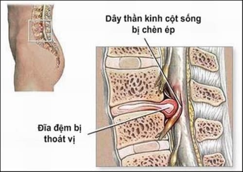 Những tổn thương về xương khớp nguyên nhân trực tiếp gây đau lưng