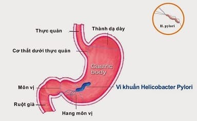 Nguyên nhân bị đau dạ dày