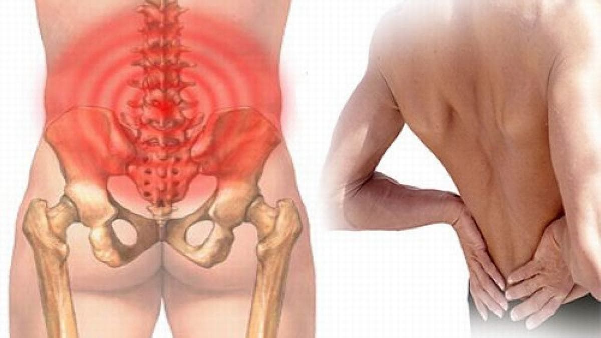 Nhận biết chứng đau dây thần kinh ở lưng