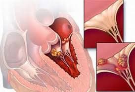 Bệnh viêm cơ tim là gì?Cách điều trị bệnh viêm cơ tim