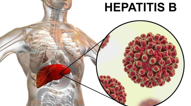 Bệnh xơ gan cổ trướng: Nguyên nhân, triệu chứng