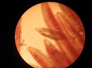 Bệnh sán lá gan là bệnh rất nguy hiểm, cần được điều trị sớm.