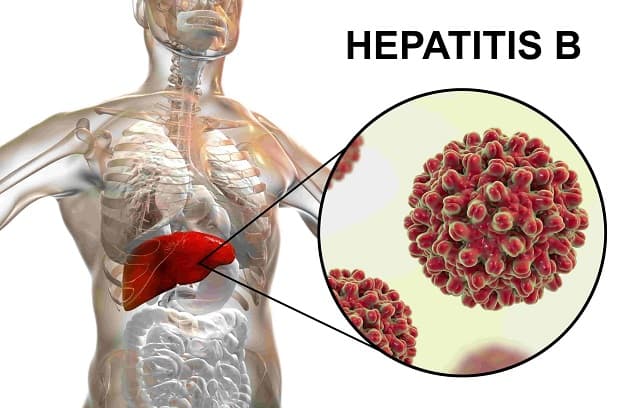 Bệnh viêm gan B cấp tính là gì?