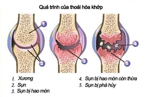 Bệnh xương khớp là gì?