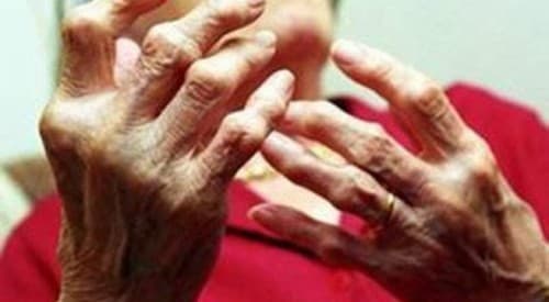 Điều trị viêm khớp dạng thấp như thế nào là quan tâm của rất nhiều người bệnh.