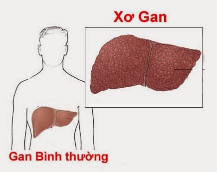 bien-chung-cua-benh-xo-gan2