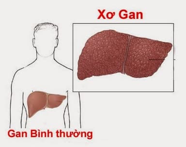 Các bệnh về gan thường gặp gan do rượu, xơ gan, ung thư gan