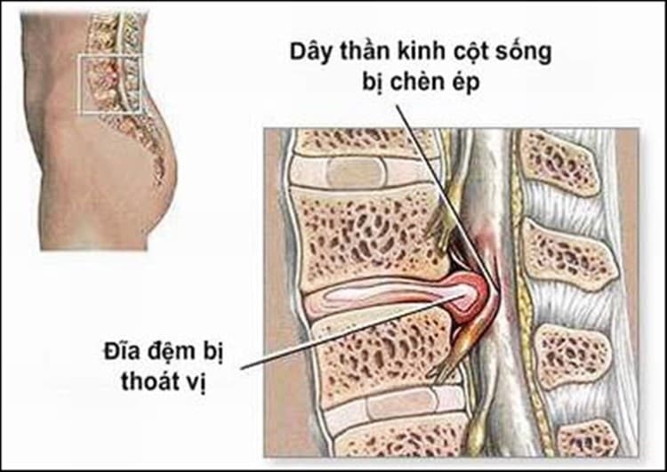 Bị thoát vị đĩa đệm cần kiêng gì