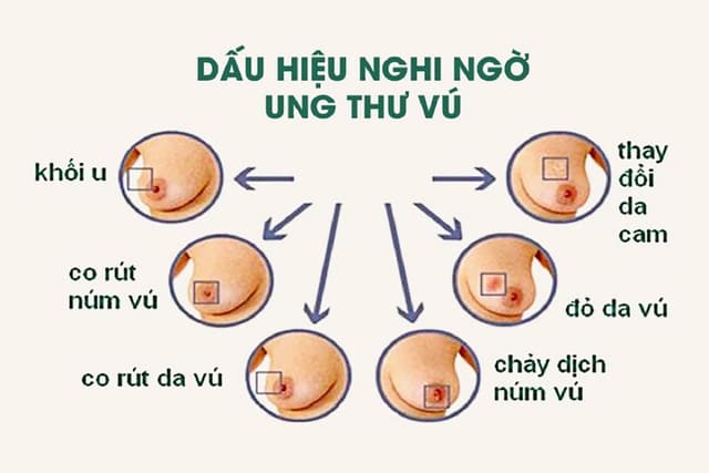 Những dấu hiệu ung thư vú chị em cần lưu tâm