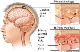 Bệnh viêm màng não mủ