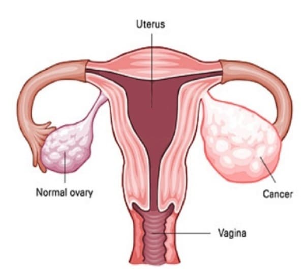 Ung thư buồng trứng.