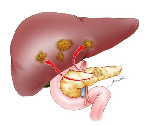 cac-benh-ung-thu-thuong-gap-o-nam-gioi1