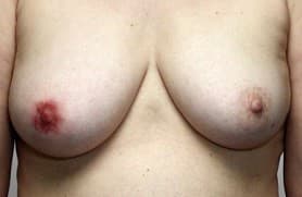 dau-hieu-ung-thu-vu (3)