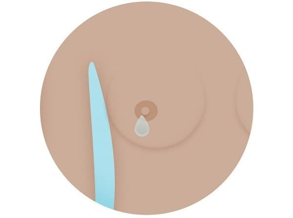 dau-hieu-ung-thu-vu (6)