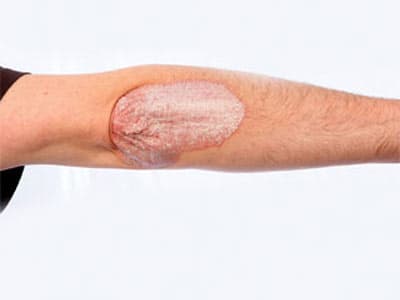 nhung-dieu-can-biet-ve-benh-vay-nen2