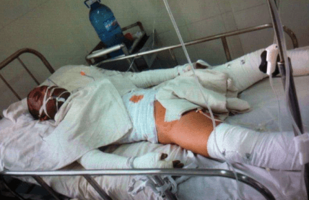 Đi bắt bệnh nhân tâm thần, điều dưỡng bị "thiêu sống"