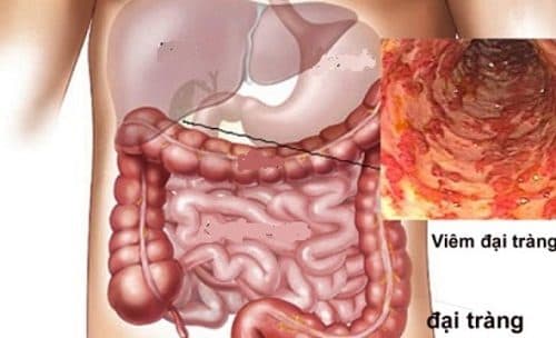 Hội chứng ruột kích thích