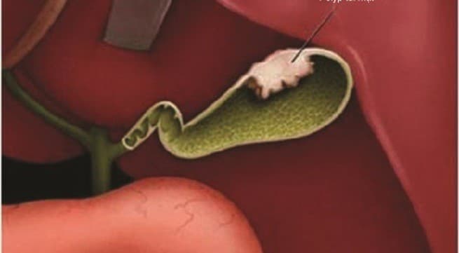 nguy-hiem-tiem-an-tu-polyp-tui-mat