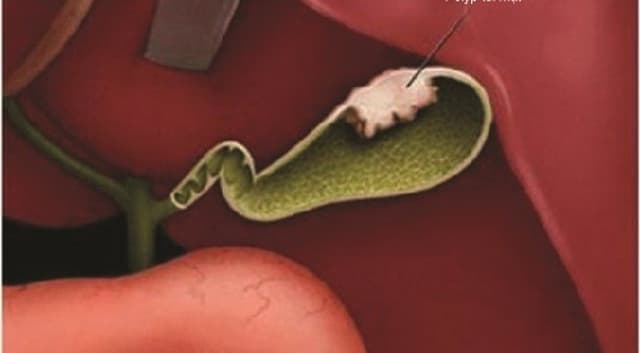 Nguy tiềm ẩn từ polyp túi mật bất kỳ tổn thương nào