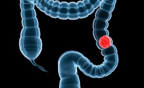 Những người bị táo bón nặng sẽ có 10% bị ung thư kết tràng.