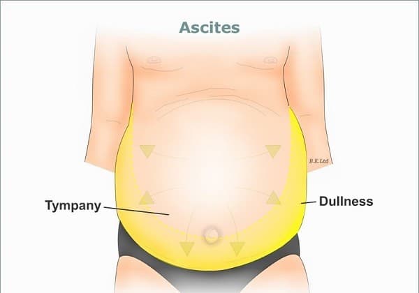 trieu-chung-ung-thu-da-day2