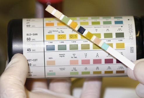 dau-hieu-ung-thu-bang-quang 